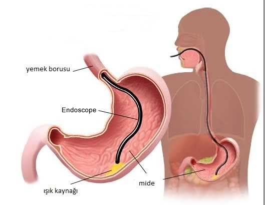 ENDOSKOPİ Gastroskopi-Kolonoskopi)